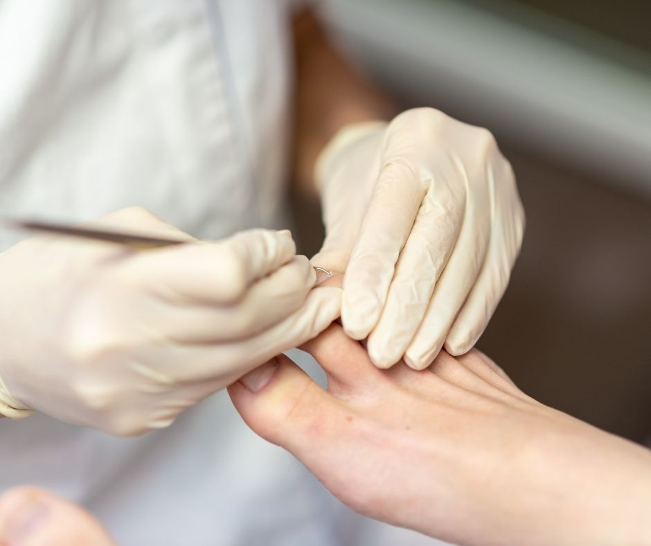 services_ingrown_toenails