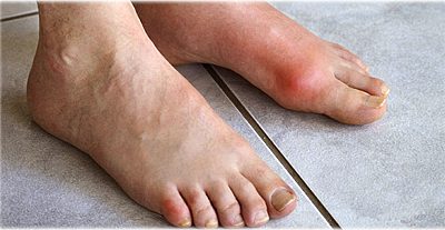Gout & Your Feet